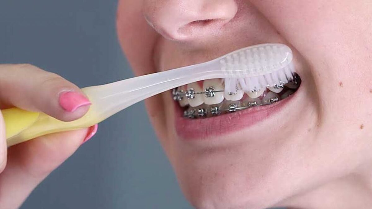 cách vệ sinh răng miệng sau khi niềng răng cách vệ sinh răng miệng sau khi niềng răng