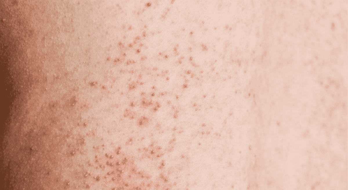 cách trị viêm nang lông ở chân cách trị viêm nang lông ở chân