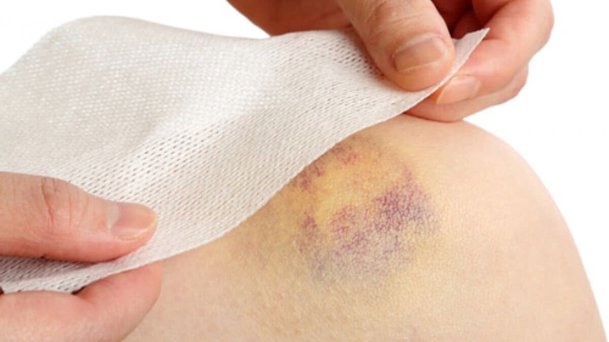 những cách làm tan vết bầm tím nhanh nhất