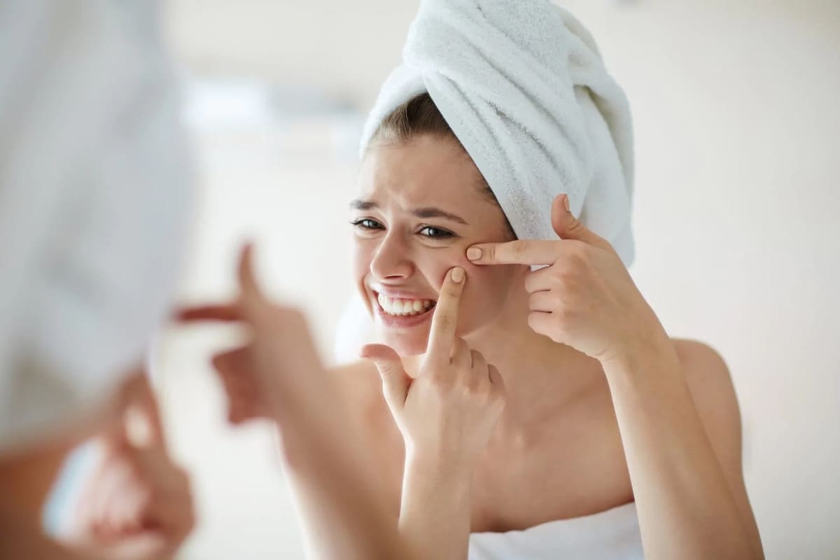 Không nặn mụn có tự hết không Không nặn mụn có tự hết không