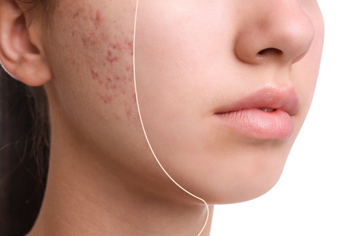 uống cà phê có nổi mụn không uống cà phê có nổi mụn không