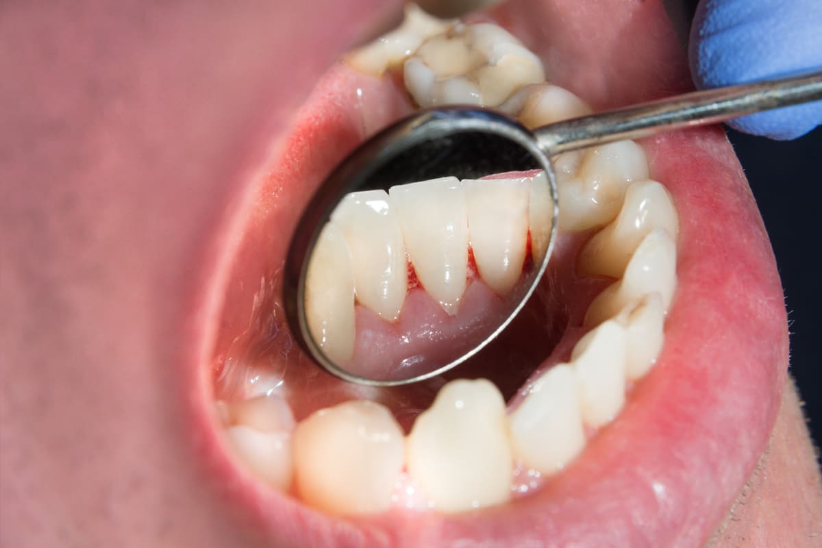 triệu chứng của tình trạng viêm nướu khi mang thai