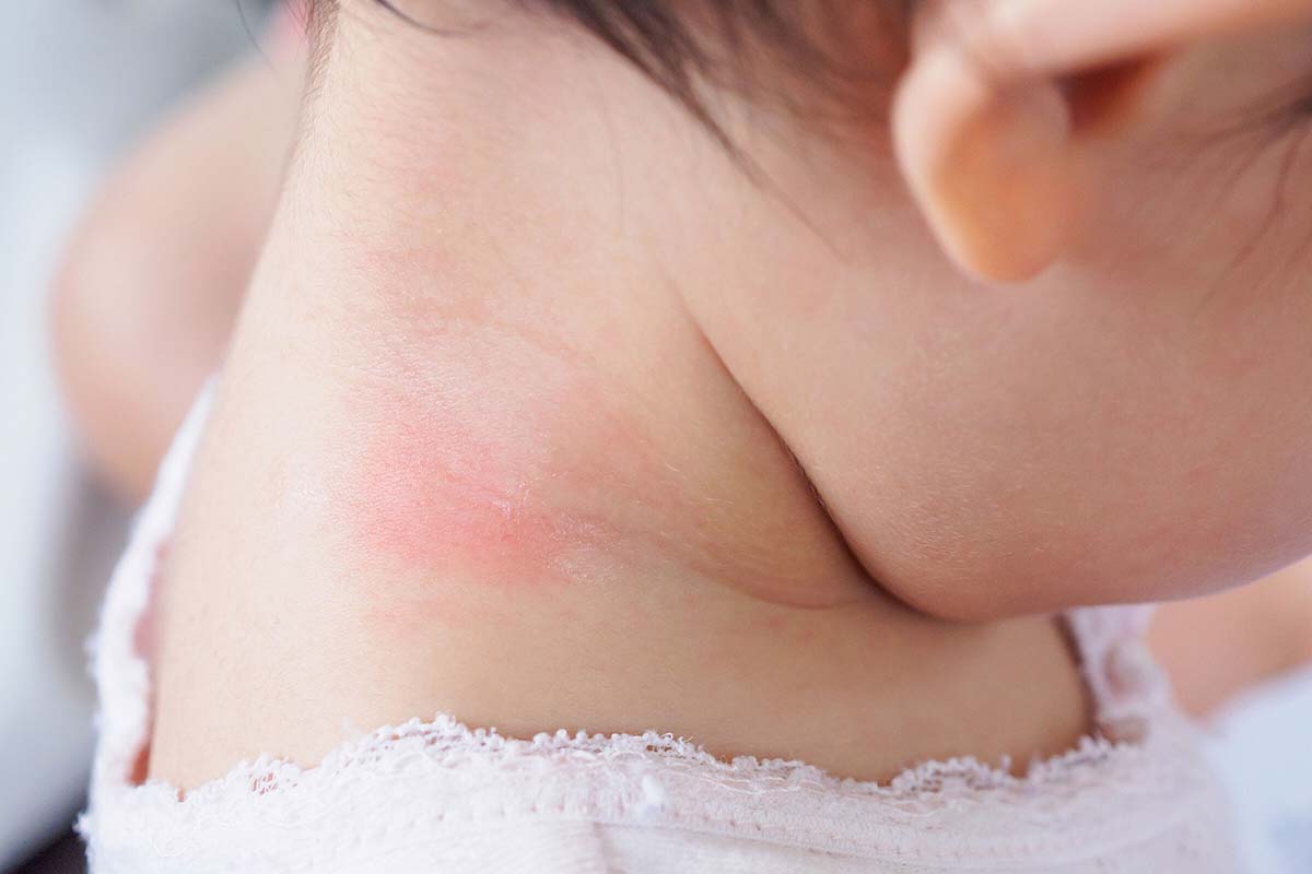 cách trị hăm cổ cho trẻ sơ sinh giúp con bớt khó chịu cách trị hăm cổ cho trẻ sơ sinh giúp con bớt khó chịu