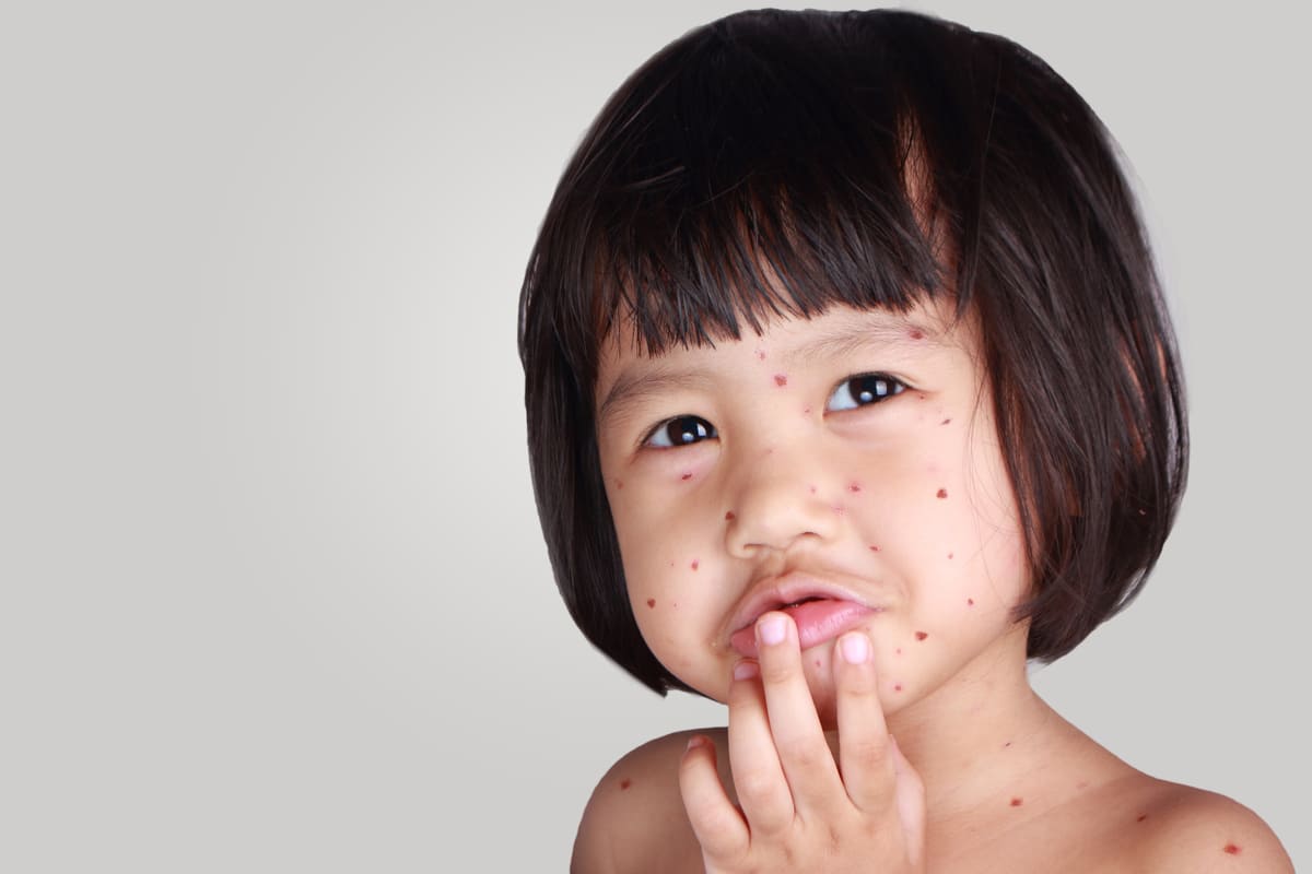 chăm sóc trẻ bị thủy đậu chăm sóc trẻ bị thủy đậu