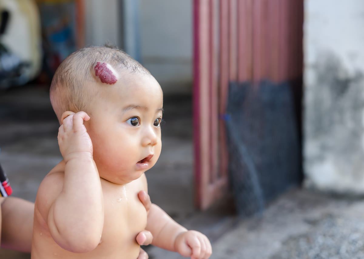 U máu ở trẻ em là gì