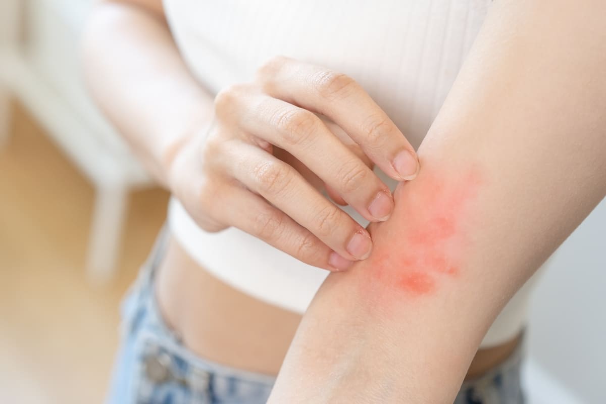 nguyên nhân gây da mẩn đỏ ngứa ngáy sau khi tắm nguyên nhân gây da mẩn ngứa sau khi tắm
