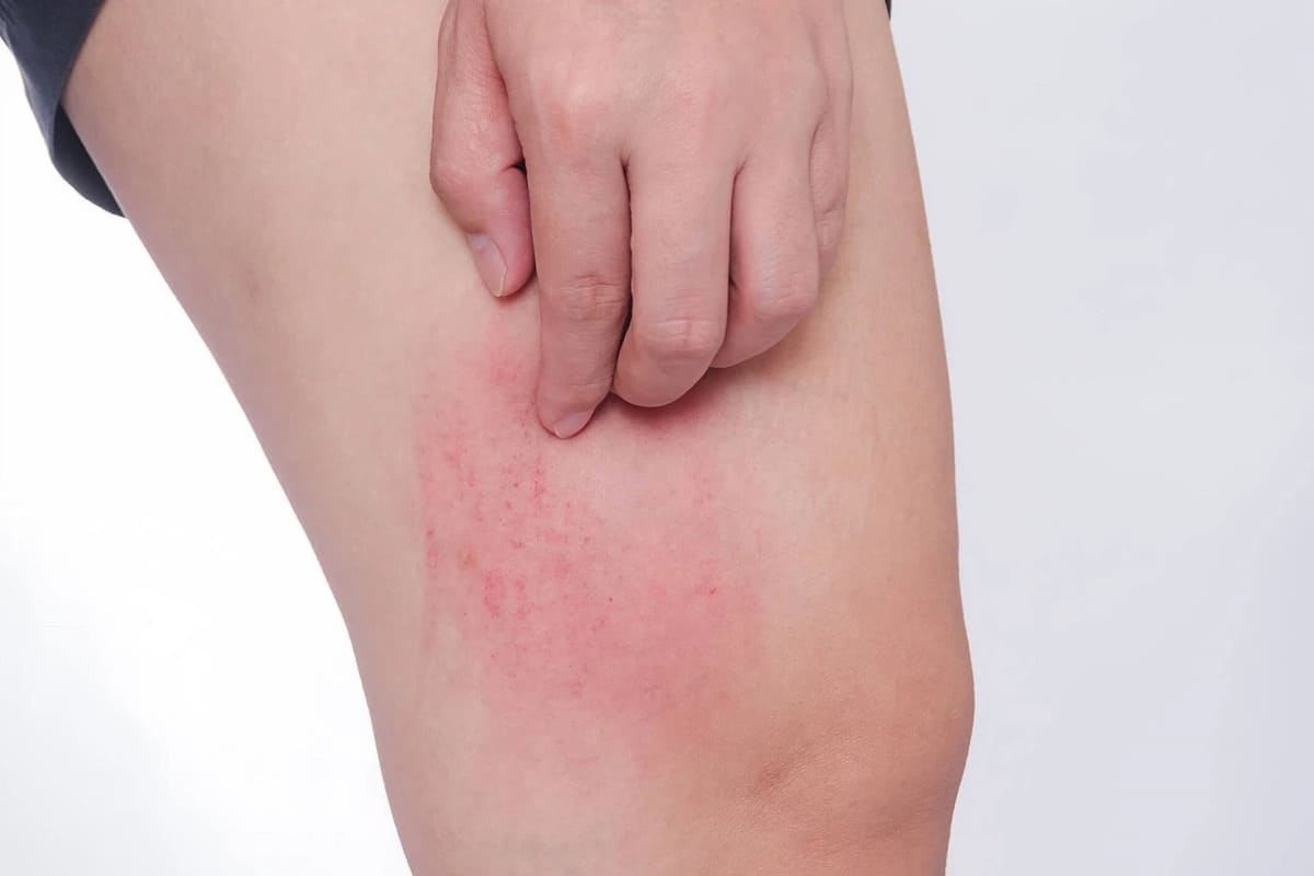 Triệu chứng của gan nhiễm mỡ
