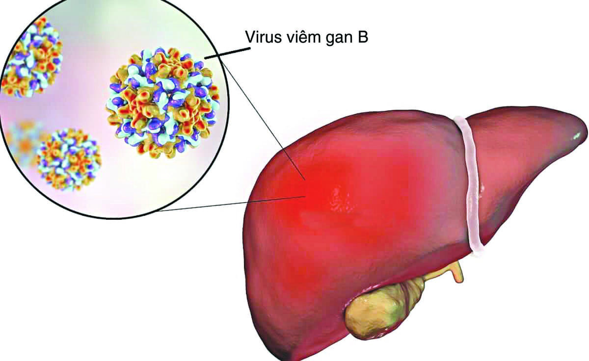 Người bị viêm gan B nên ăn gì và kiêng ăn gì? 33 viêm gan b