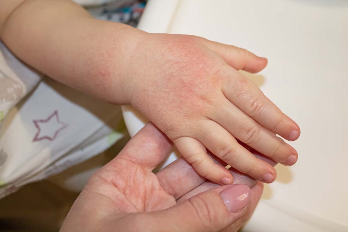 Trẻ bị chàm tay nên có biện pháp xử lý nhanh chóng Trẻ bị chàm tay nên có biện pháp xử lý ngay