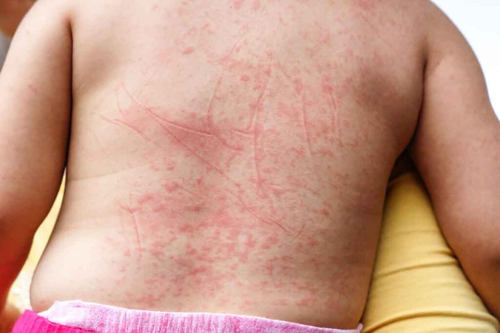 Phát ban sốt xuất huyết trẻ em: Nguyên nhân và cách điều trị