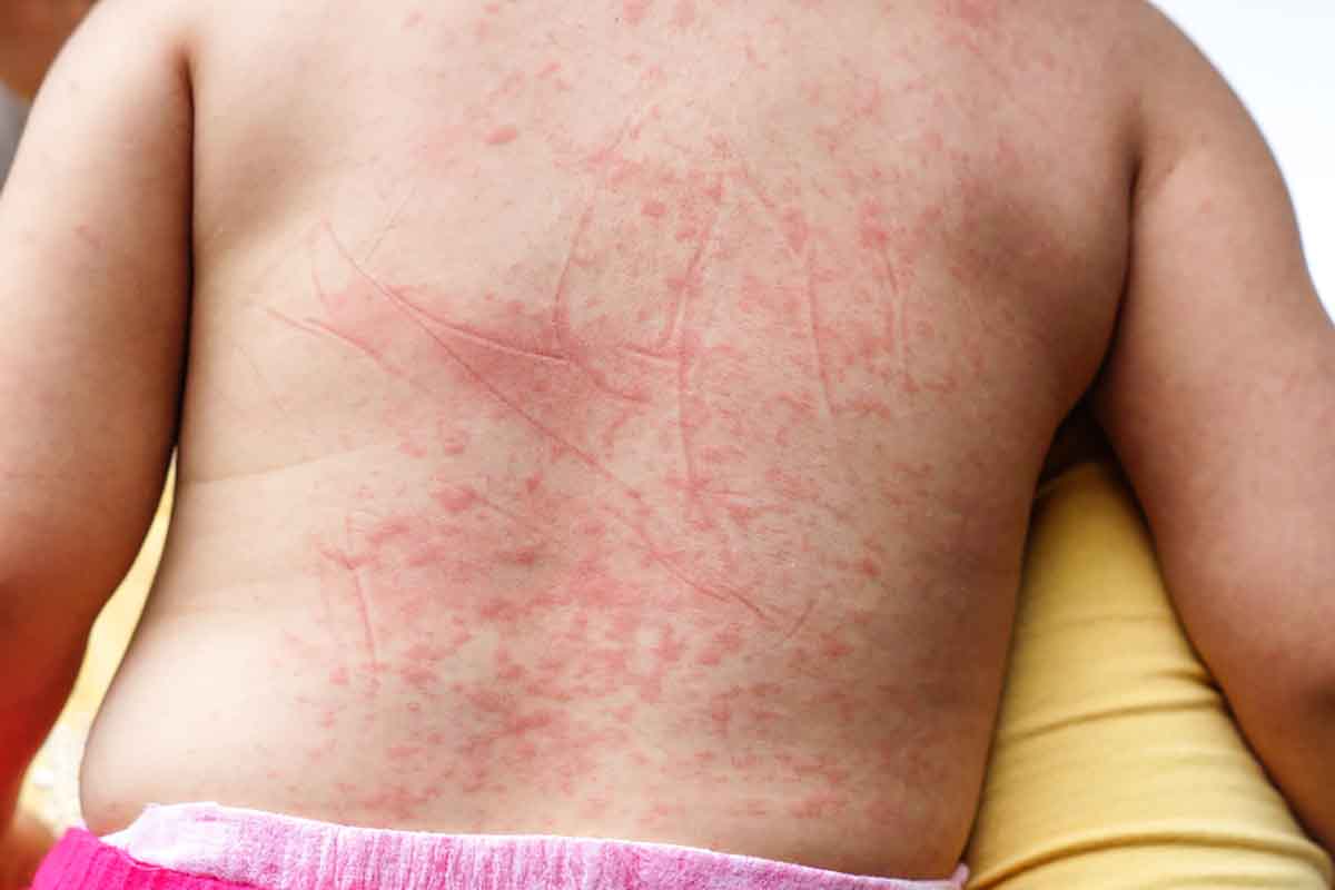 Phát ban sốt xuất huyết trẻ em: Nguyên nhân và cách điều trị