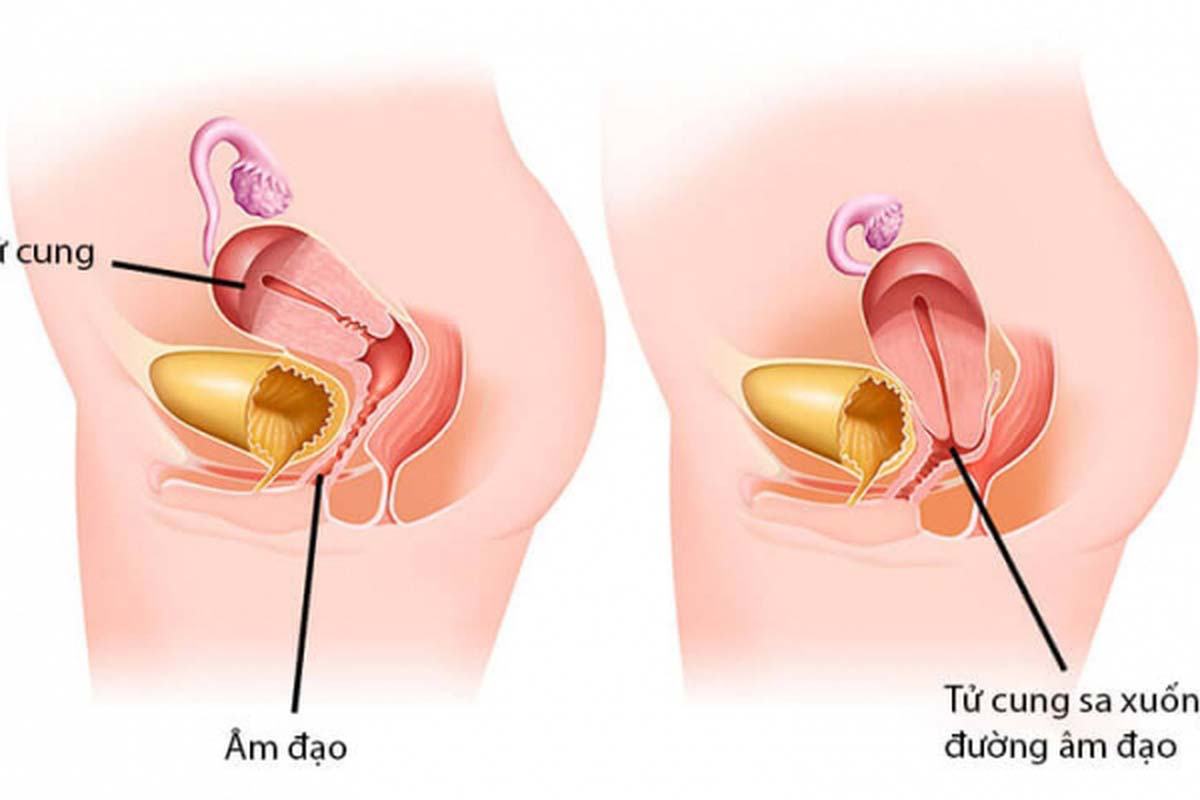 Mẹ sau sinh bao lâu thì được ngồi xổm mà không bị sa dạ con Mẹ sau sinh bao lâu thì được ngồi xổm mà không bị sa tử cung