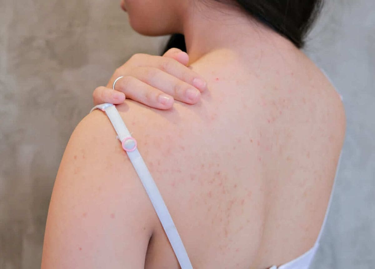 điều trị mụn lưng tại nhà hiệu quả cách trị mụn lưng tại nhà hiệu quả