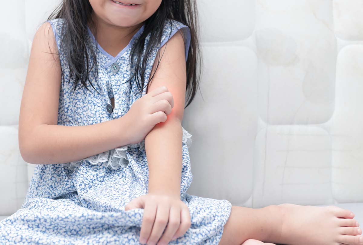 Khi bị viêm da mủ, trẻ hay gãi