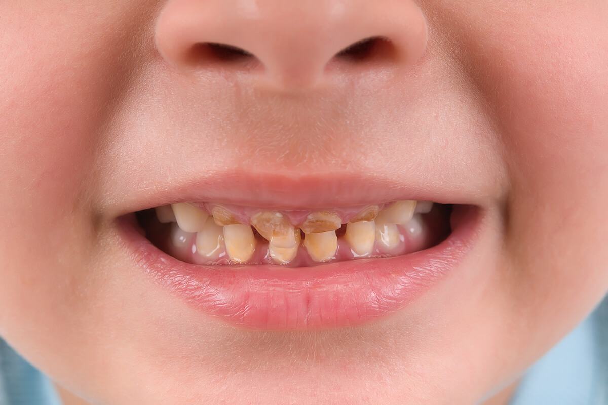 chăm sóc răng miệng răng trẻ bị đen