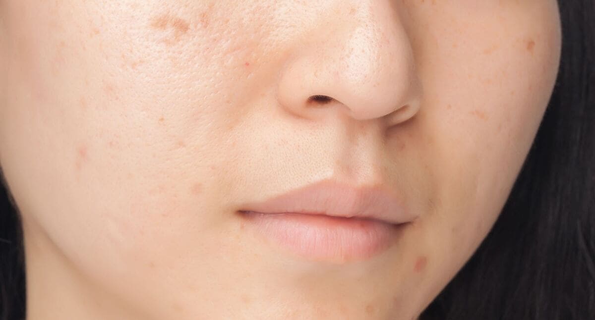 cách trị sẹo mụn Nguyên nhân gây sẹo mụn