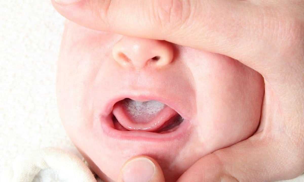 không rơ lưỡi cho trẻ sơ sinh có thể khiến trẻ bị tưa lưỡi không rơ lưỡi cho trẻ sơ sinh có thể gây tưa lưỡi