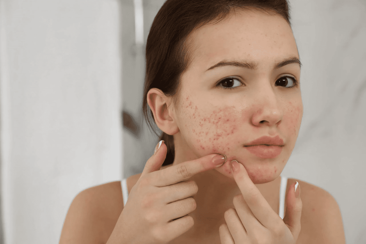 cách trị thâm mụn