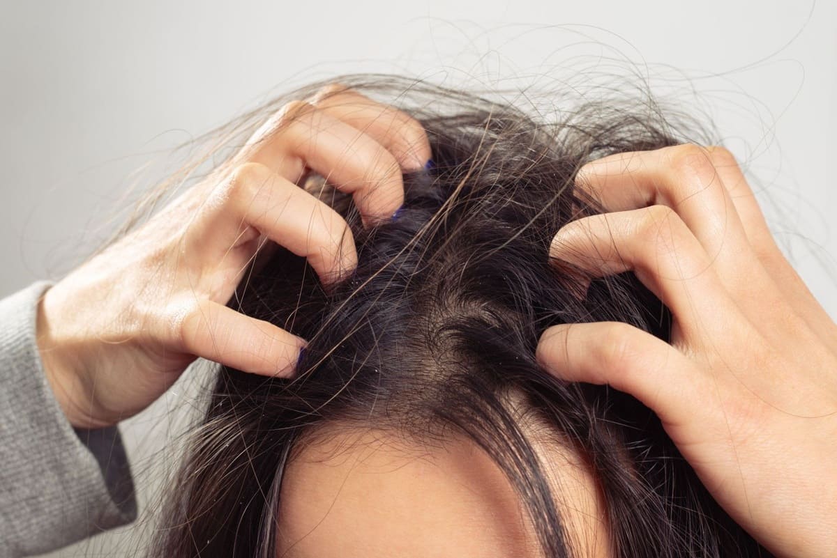 triệu chứng da đầu gàu và ngứa 10 nguyên nhân da đầu gàu và ngứa