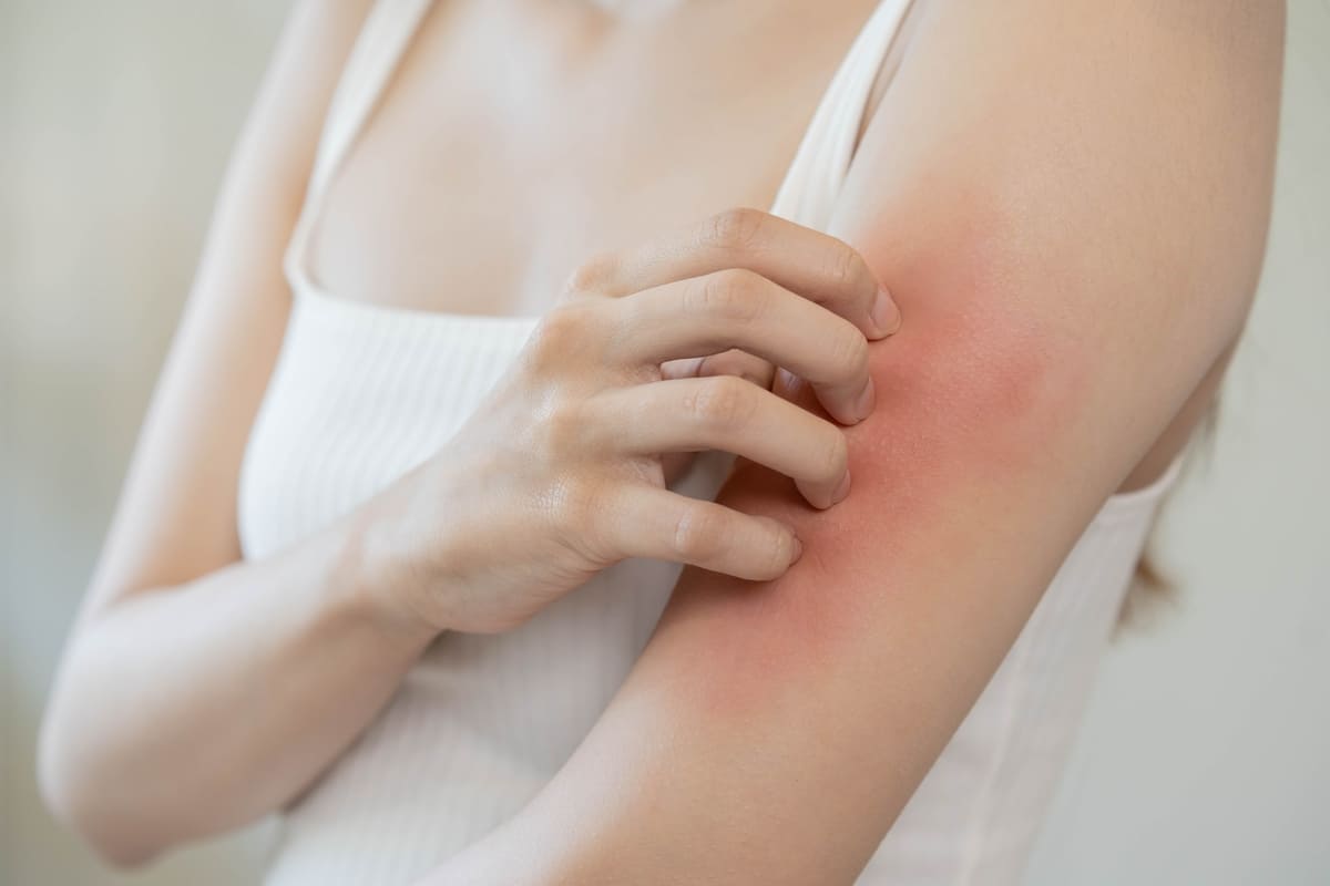 da bị dị ứng nước biển