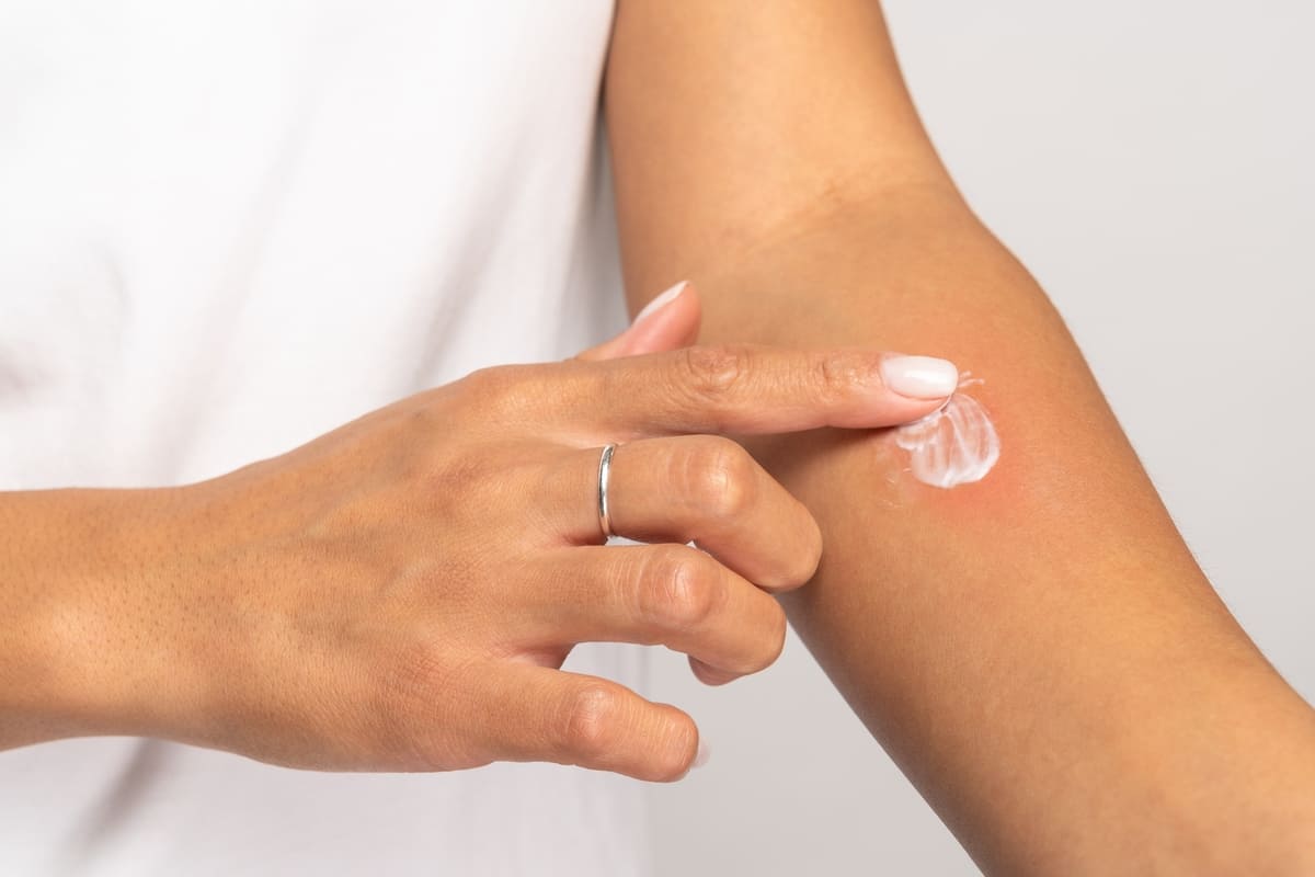 Cách xử lý khi bị dị ứng nước biển