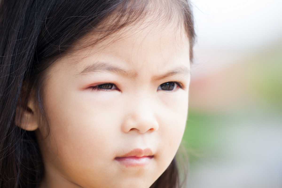 Viêm kết mạc có lây không? Làm gì khi trẻ bị viêm kết mạc cấp?