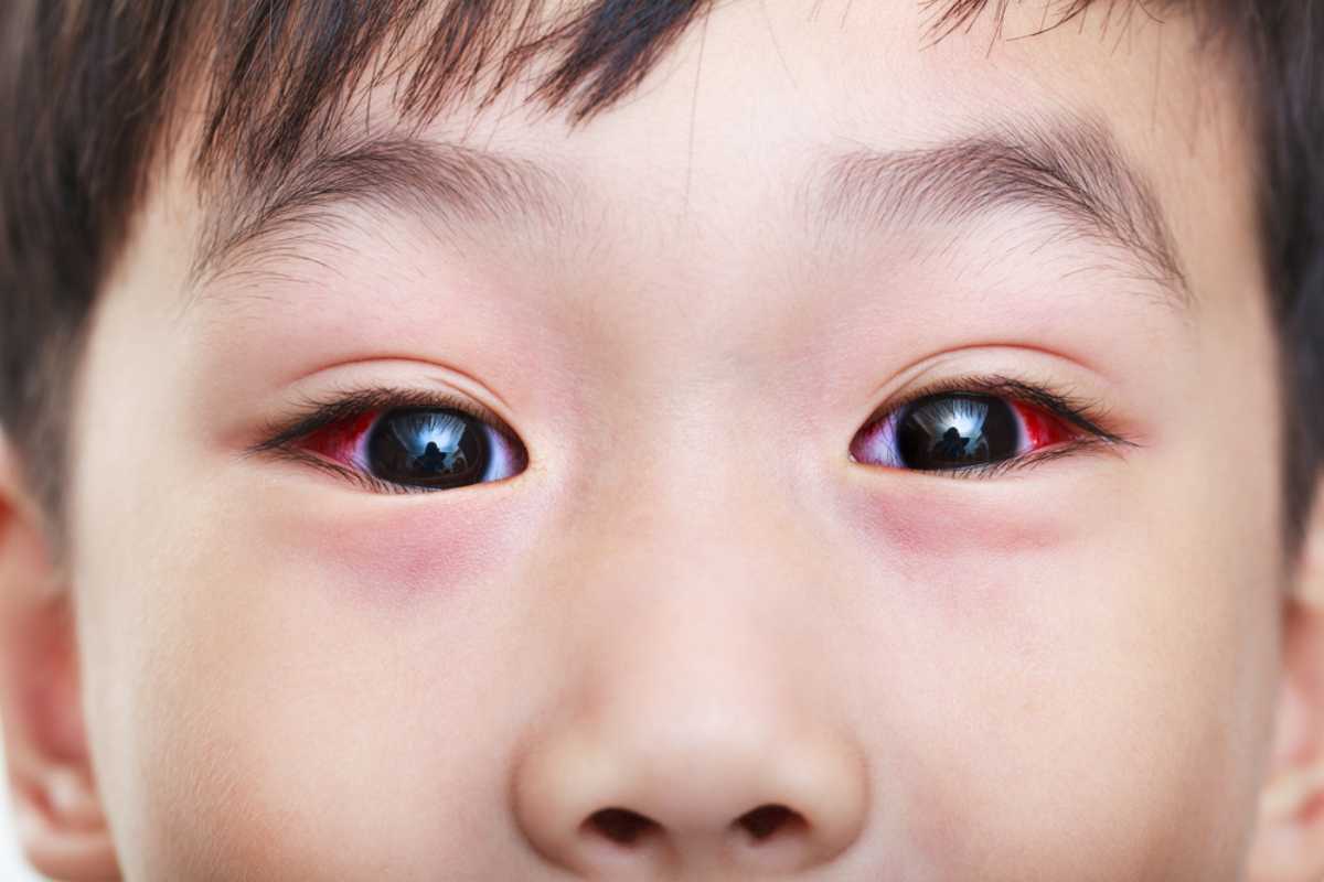 Bé bị viêm kết mạc có lây không Trẻ bị viêm kết mạc có lây không