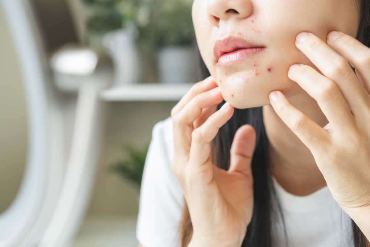Da mặt đột nhiên nổi nhiều mụn: Nguyên nhân và cách điều trị 3