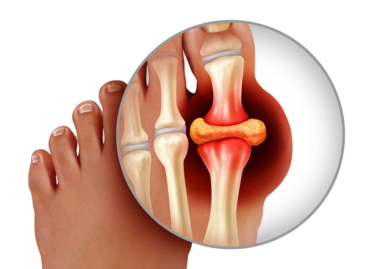 người bệnh gút nên ăn gì bệnh gút là gì