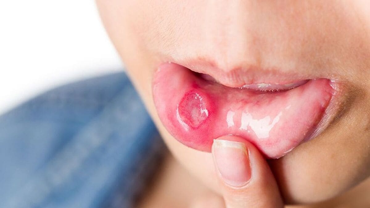 nguyên nhân bị nhiệt miệng bị nhiệt miệng là gì