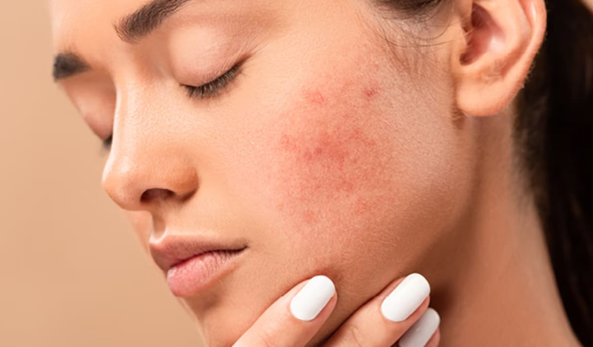 phương pháp chườm đá lên mặt Những lợi ích của phương pháp chườm đá lên mặt