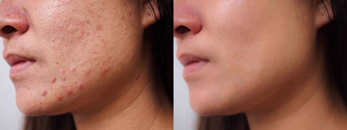mặt nạ trị thâm mụn tại nhà Nguyên nhân dẫn đến thâm mụn