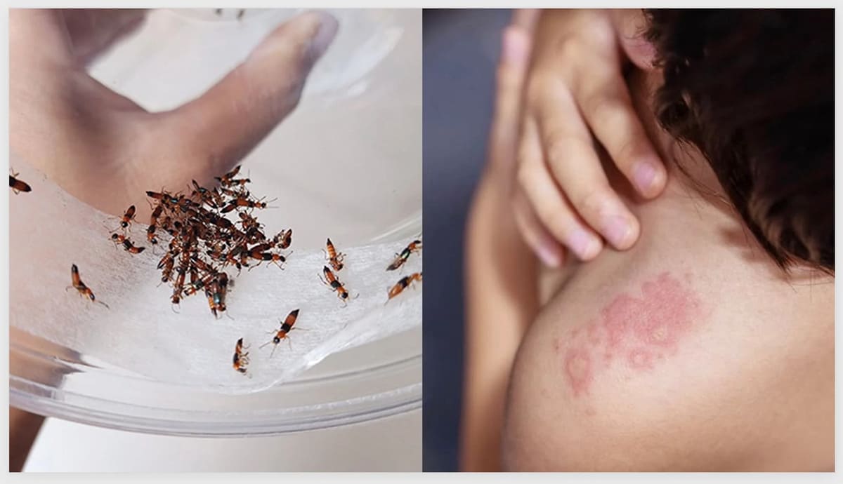 bị kiến ba khoang cắn