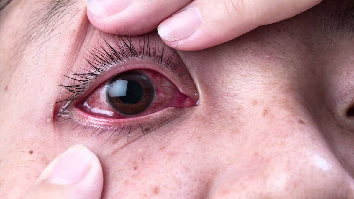 bị đau mắt đỏ bệnh đau mắt đỏ
