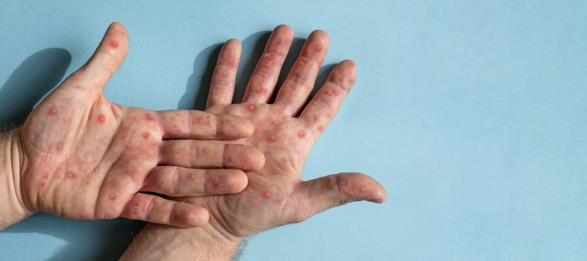 Các triệu chứng đậu mùa khỉ