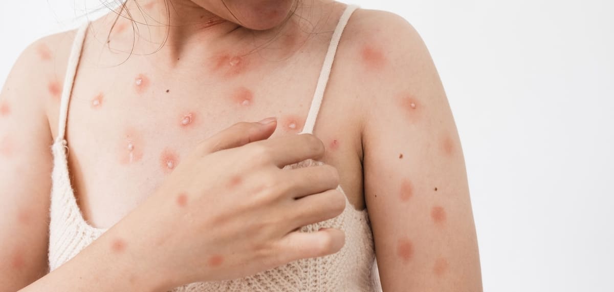 Bệnh đậu mùa khỉ là gì