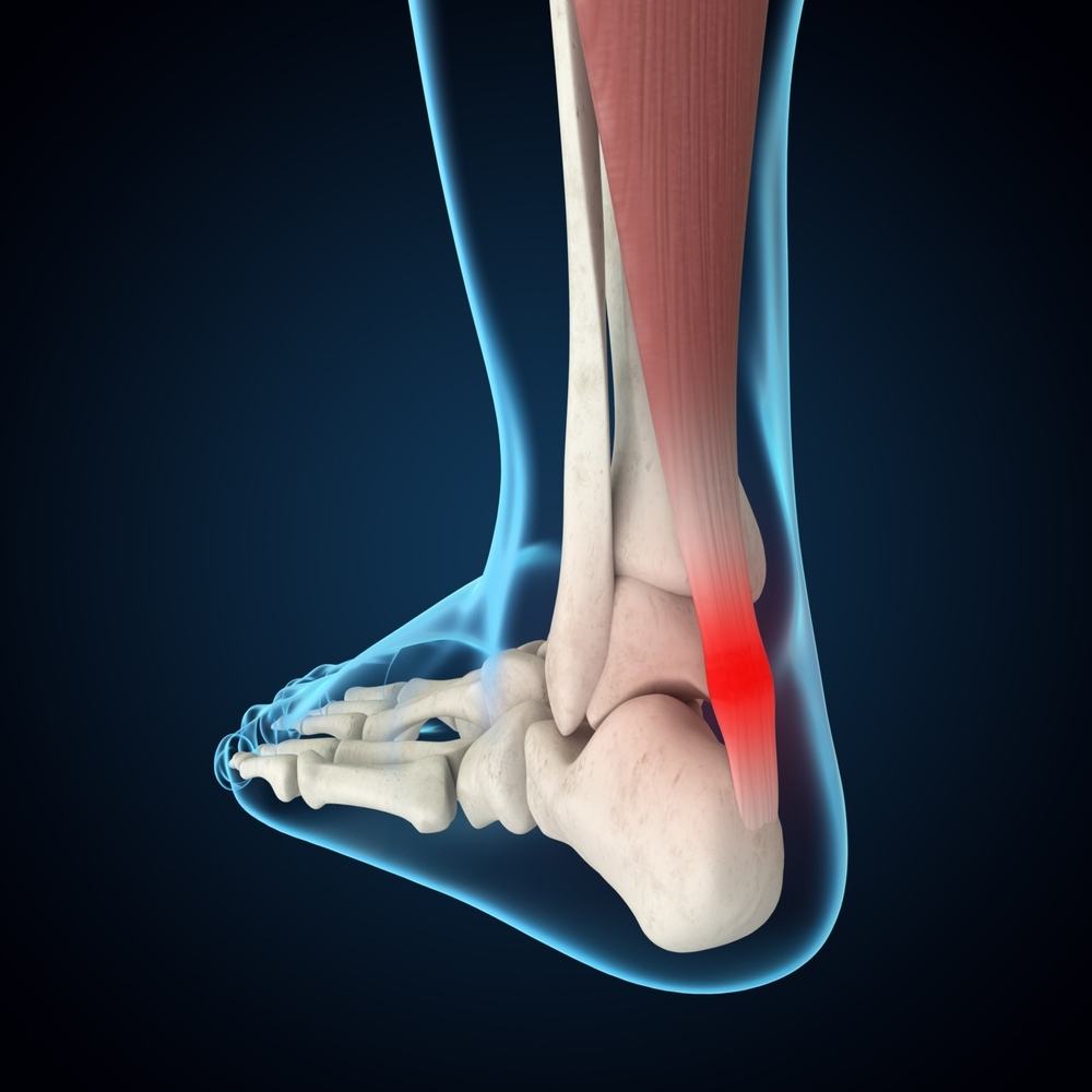 đau gót chân là bị gì là bị viêm gân achilles đau gót chân là bị gì là viêm gân achilles
