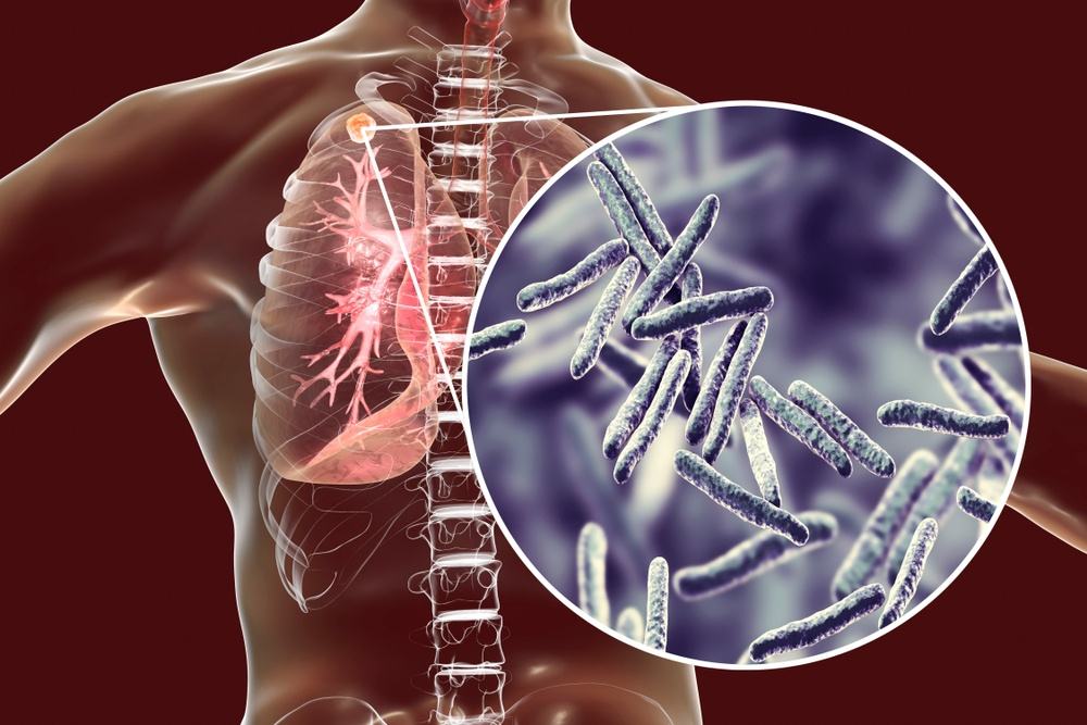 dấu hiệu bệnh lao phổi cần chú ý dấu hiệu bệnh lao phổi cần lưu ý