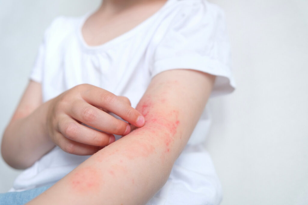 Cha mẹ nhớ chú ý dấu hiệu nhiễm sán chó ở trẻ em nguy hiểm này