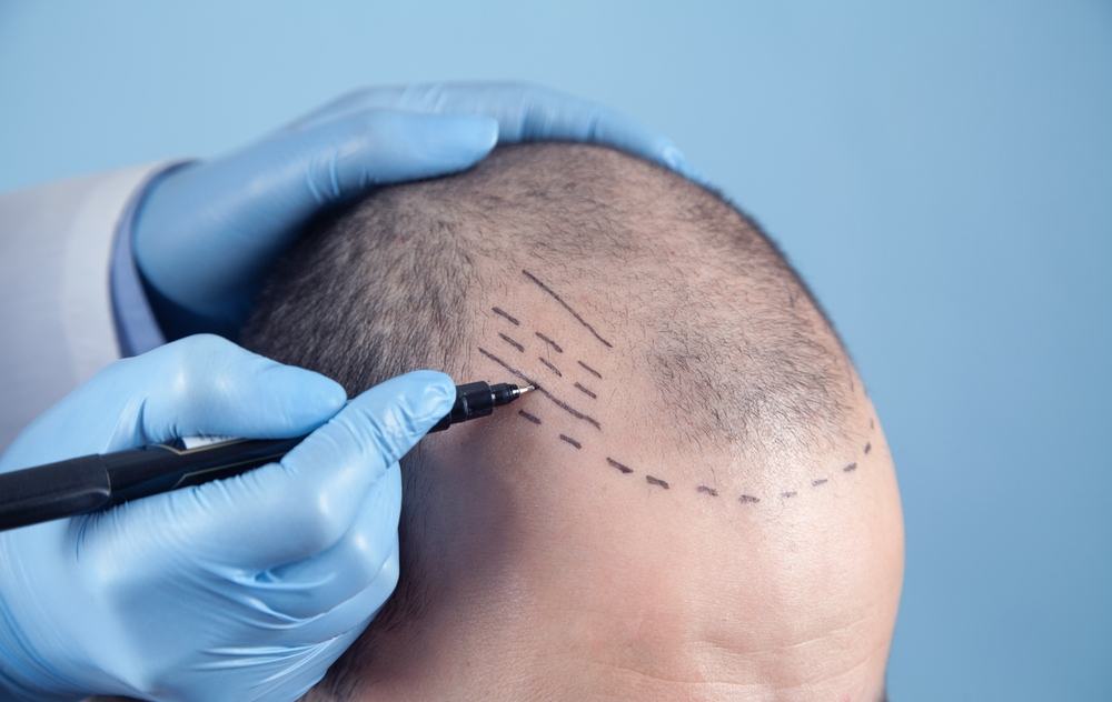 Có nên cấy tóc khi bị rụng tóc nhiều và những điều bạn cần biết 5