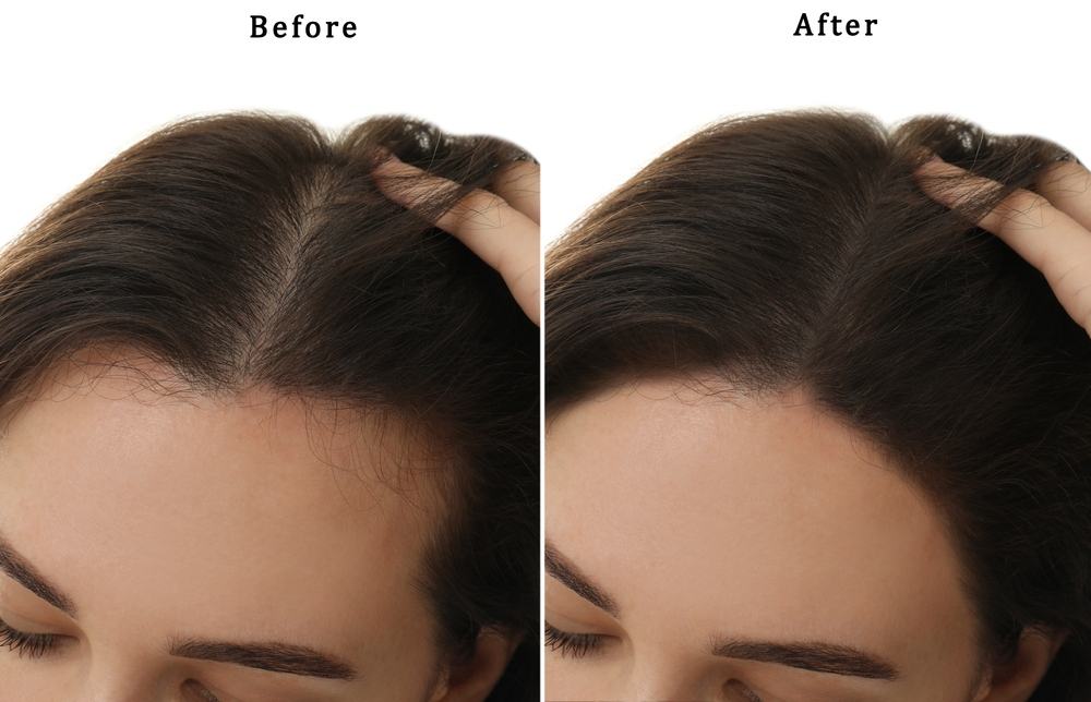 Có nên cấy tóc khi bị rụng tóc nhiều