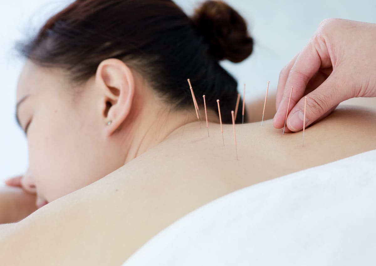 7 lợi ích sức khỏe tiềm ẩn của châm cứu, bạn nên tận dụng 38 châm cứu giúp ngủ ngon