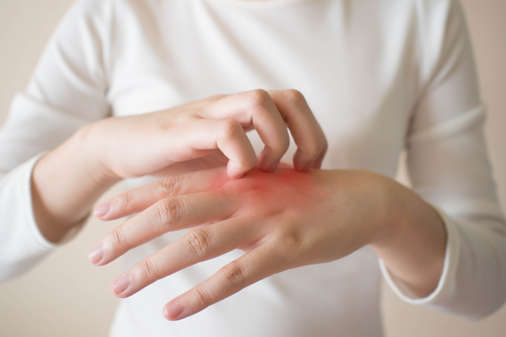 Chàm dị ứng có lây không và xử lý thế nào để nhanh khỏi bệnh