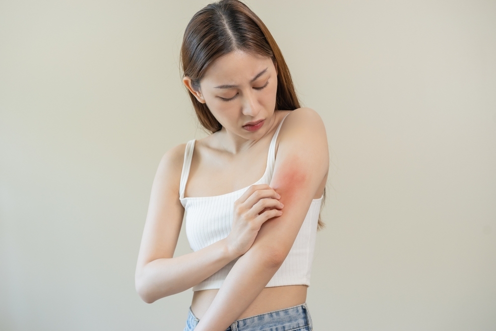 bệnh chàm dị ứng
