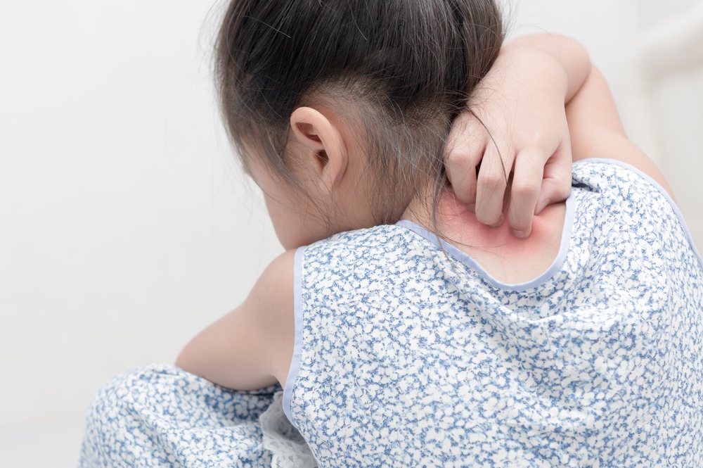 chàm dị ứng ở trẻ nhỏ