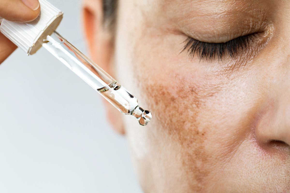 Chia sẻ cách điều trị nám da ở tuổi trung niên