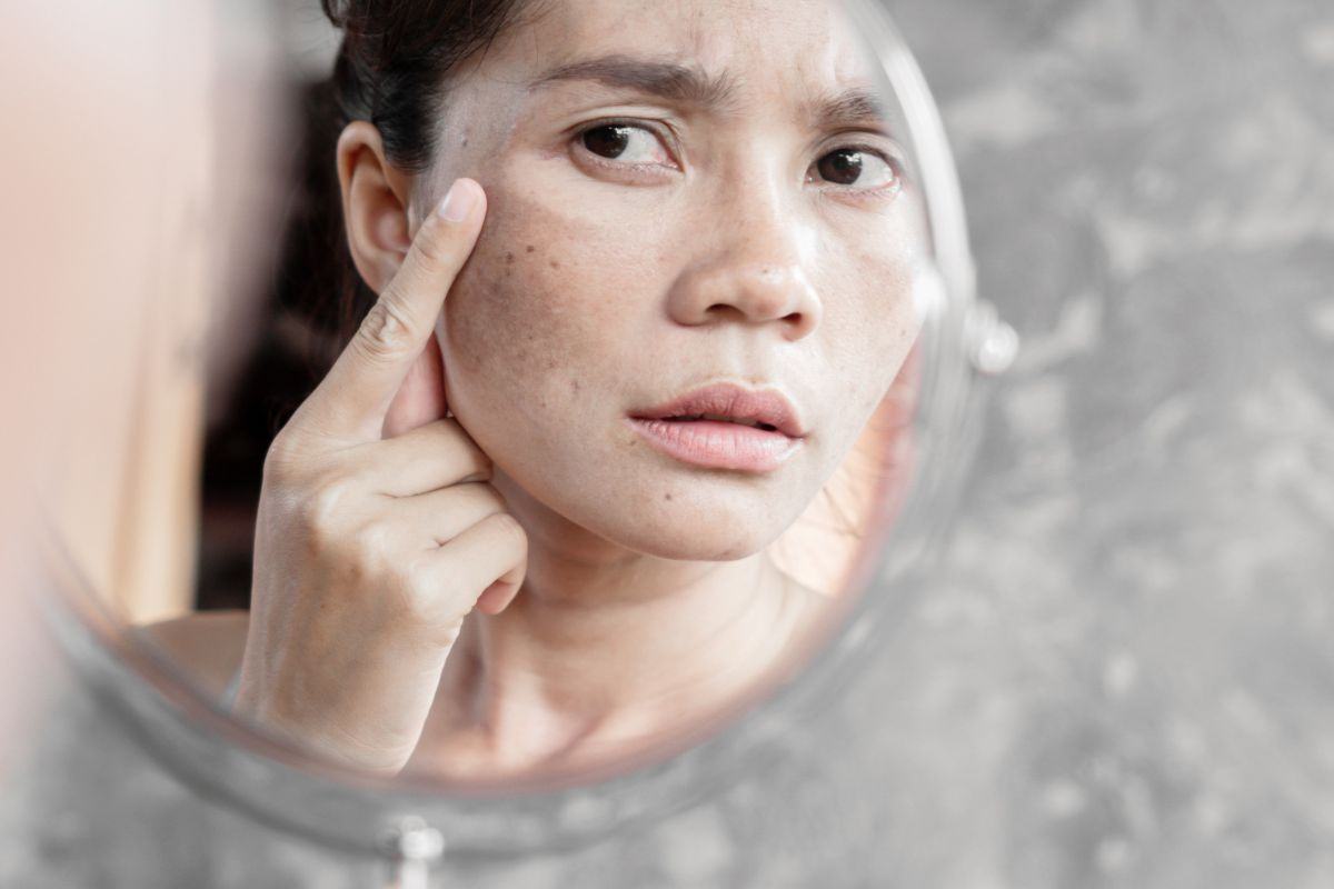 4 nguyên nhân gây nám da ở tuổi trung niên