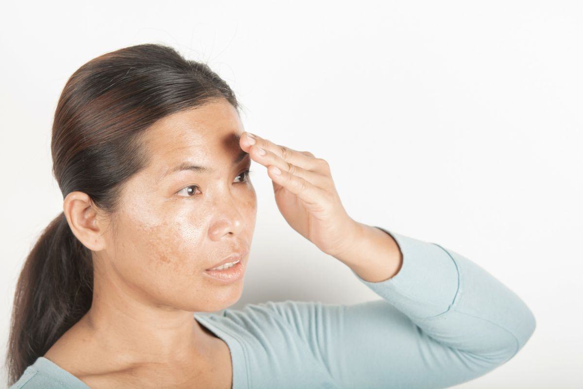 Nám da ở tuổi trung niên