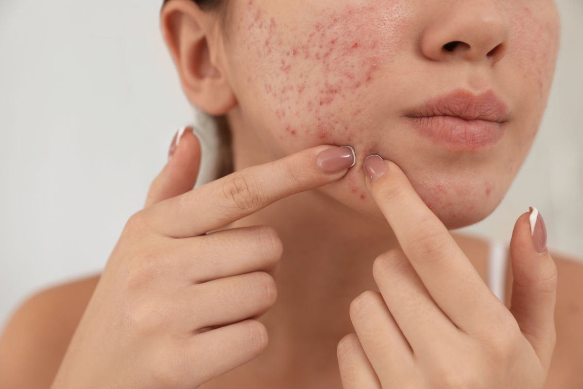 Da mụn mụn nội tiết