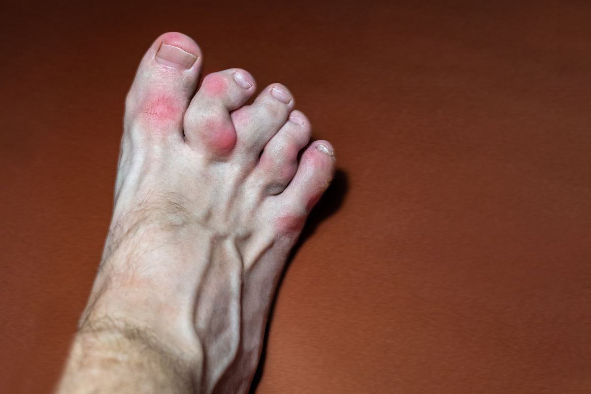 benh-gout-sung-dau Điểm danh 3 nguyên nhân bệnh gout tăng cao sau Tết